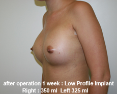plastic-surgery-breast-augmentation